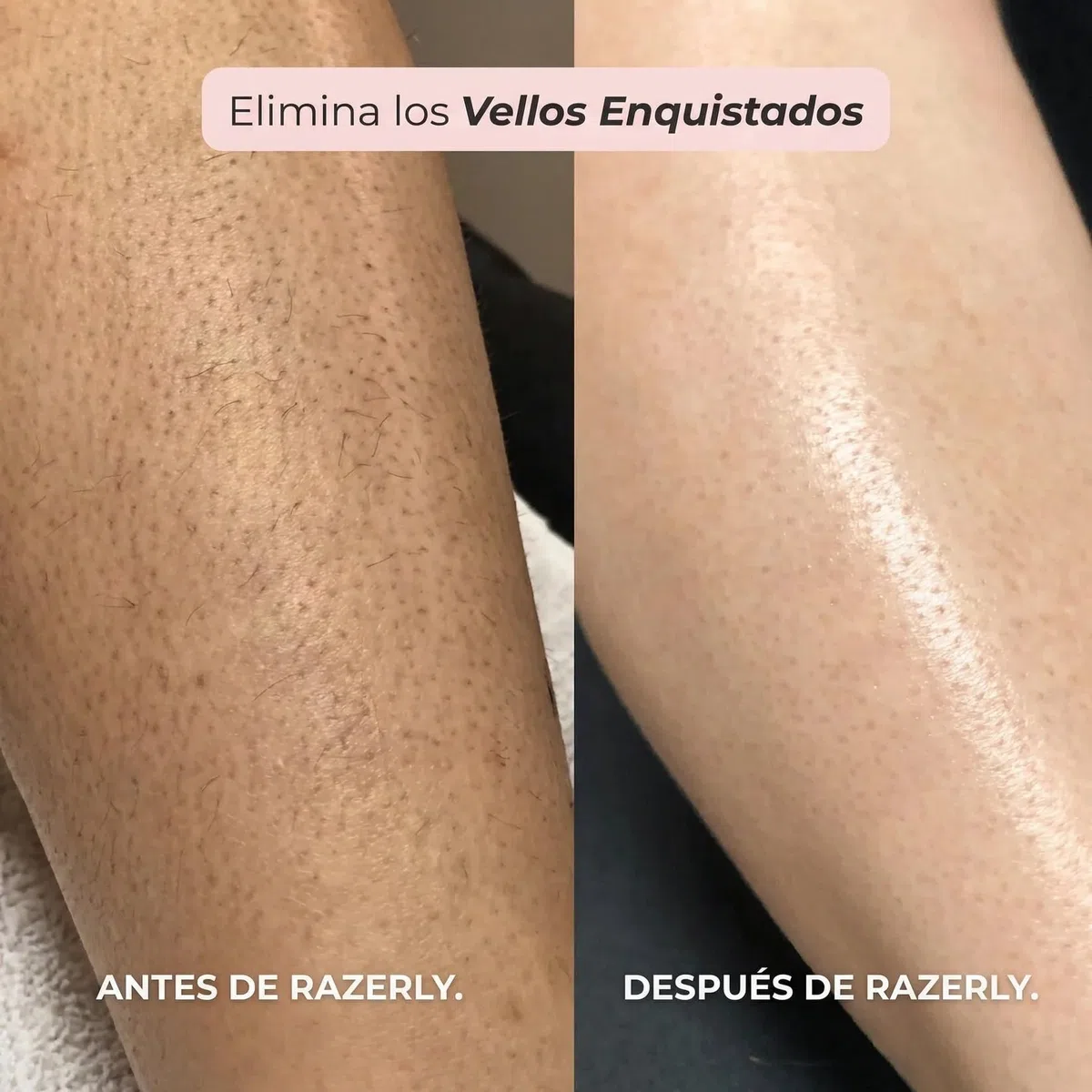 Razerly Maquinilla Mujer, Maquinilla 2 En 1para Bikini Ycuerpo Razerly, Razerly Depiladora, Maquinilla Electrica Femenina Para Zona Intima Axilas Piernas Y Piel Sensible (Azul)
