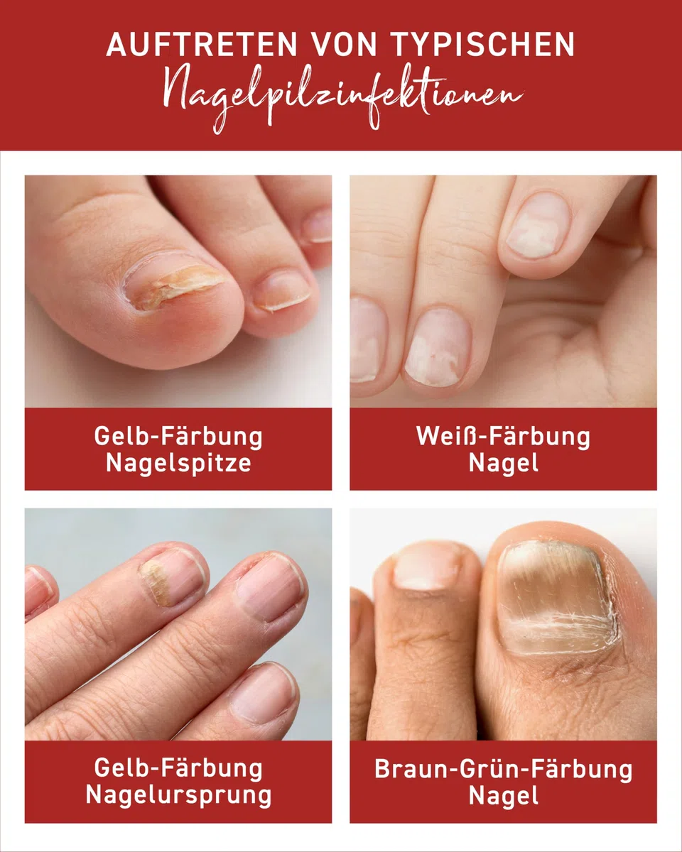 N1 Solución para hongos en las uñas, 20 ml, producto médico para un tratamiento intensivo rápido, calidad de farmacia con efecto demostrado, esmalte de uñas para tratamiento de hongos en las manos y