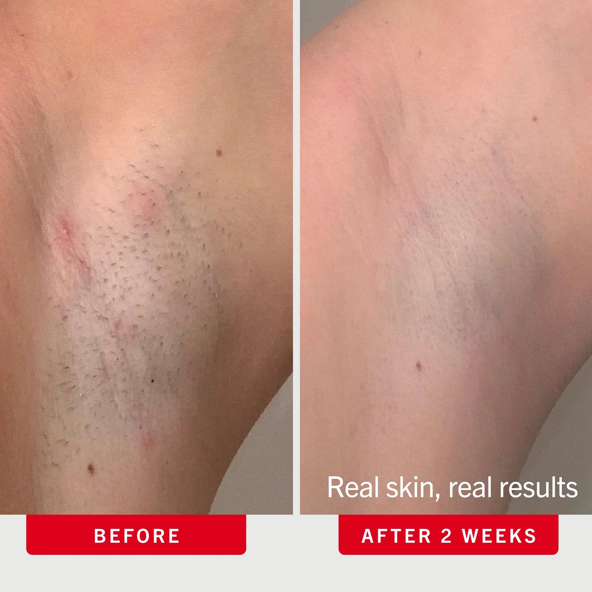 First Aid Beauty - Almohadillas de piel con BHA y AHA para el tratamiento diario, alivia las quemaduras de afeitar, previene el vello encarnado y alivia la irritación, 60 almohadillas