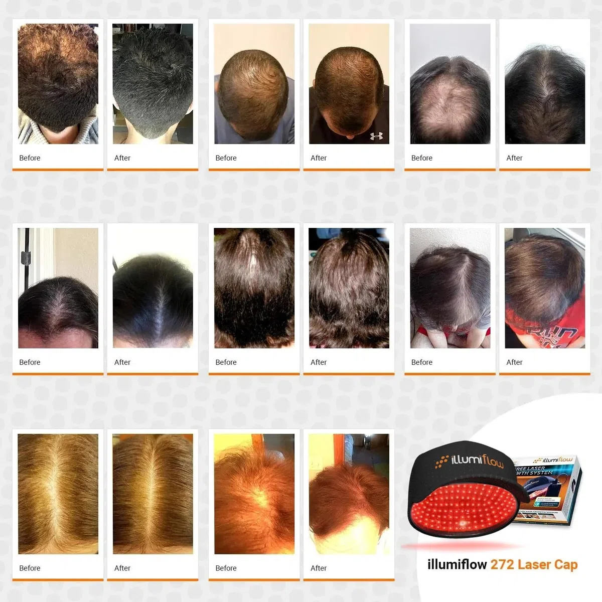 illumiflow 272 Diodos Laser Cap, tratamiento de pérdida de cabello fino para hombres y mujeres. Estimula los folículos del cabello para cabello más grueso