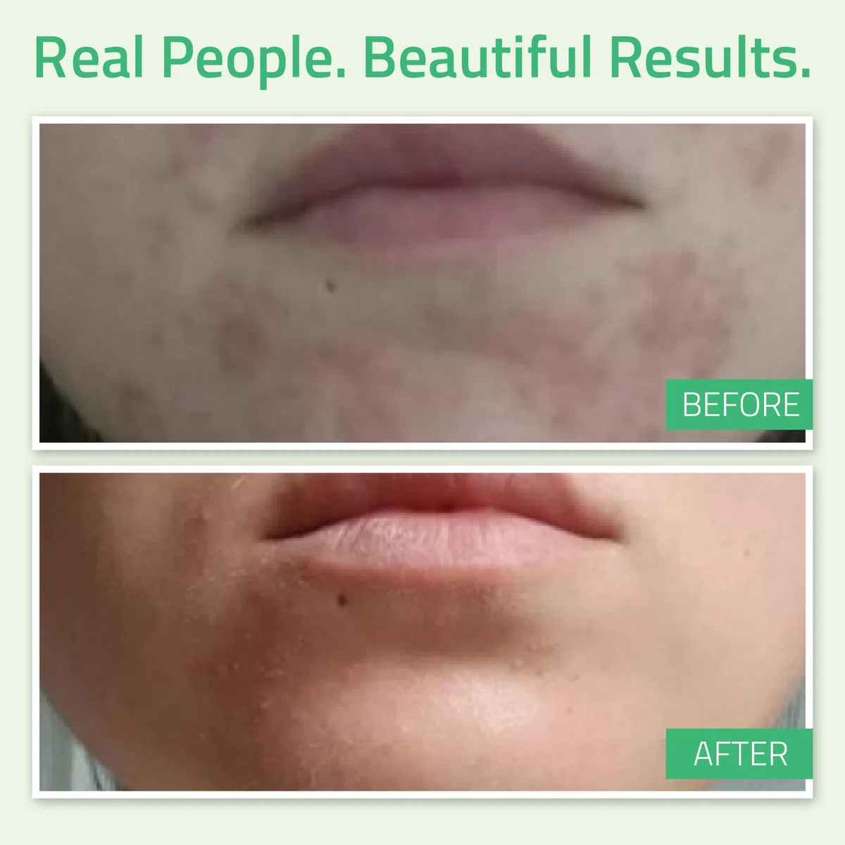 YEOUTH Peeling Ácido Glicólico 30% Cuidado Facial Profesional con Retinol y Té Verde, Exfoliante Facial Skin Care Mujer y Hombres 60ml